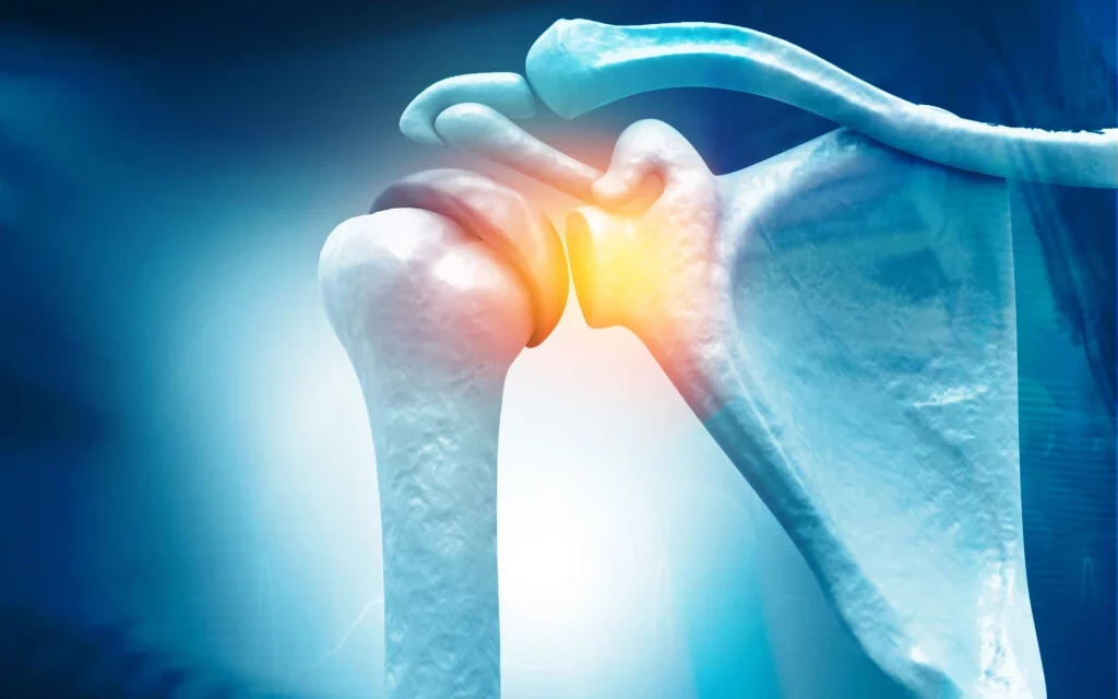 Denied Workers’ Comp for Rotator Cuff Surgery. What Now?