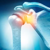 Rotator Cuff Surgery Workers Comp