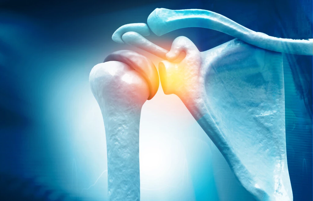 Rotator Cuff Surgery Workers Comp