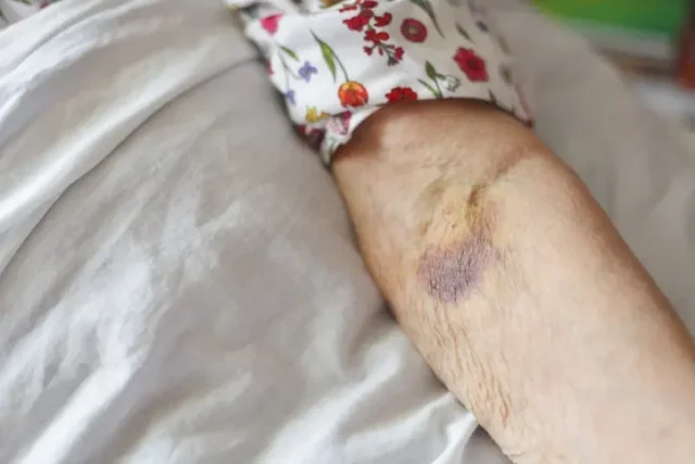 Bruises caused by nursing home abuse in Alabama.
