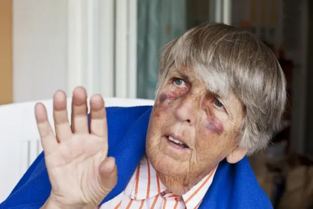 An old person raising her hand in mercy, with multiple bruises on her face. One of the signs of nursing home abuse in Arizona.