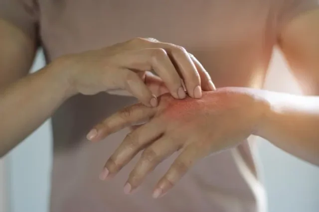 Chemical injury on a woman's hand.