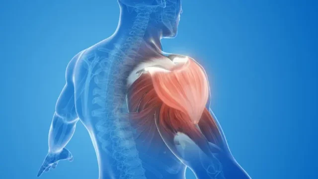 A diagram of a man experiencing musculoskeletal injury on his right shoulder.